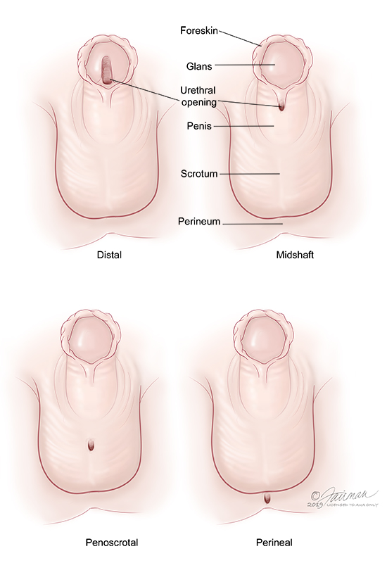 pediatric urology: Hypospadias pyeloplasty, undescended testis, and UR management by Dr. haprit Singh