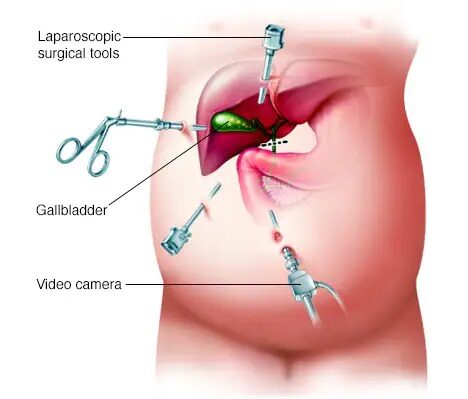 Laparoscopic Surgery – Lap Cholecystectomy