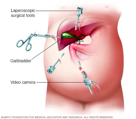 Laparoscopic Surgery – Lap Cholecystectomy