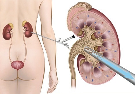 kidney stone treatment: PCNL, Mini PCNL, RIRS