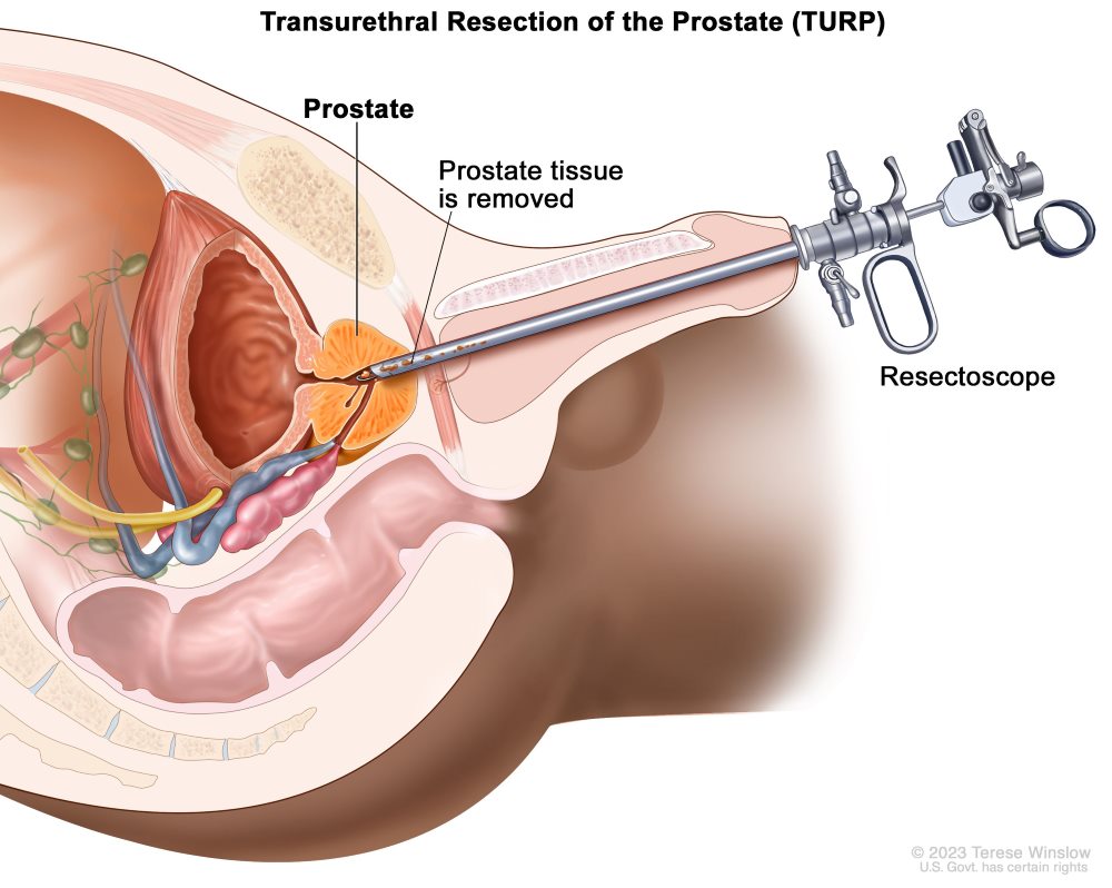 Urovita Hospital: Pioneering Treatment for Prostate Cancer, Penile Cancer, and Adrenal Tumors