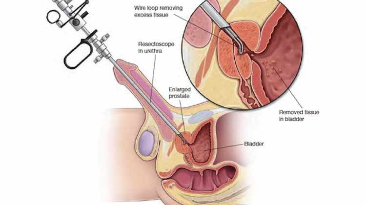 Prostate Enlargement (BPH): TURP, Bipolar TURP, Laser Operation