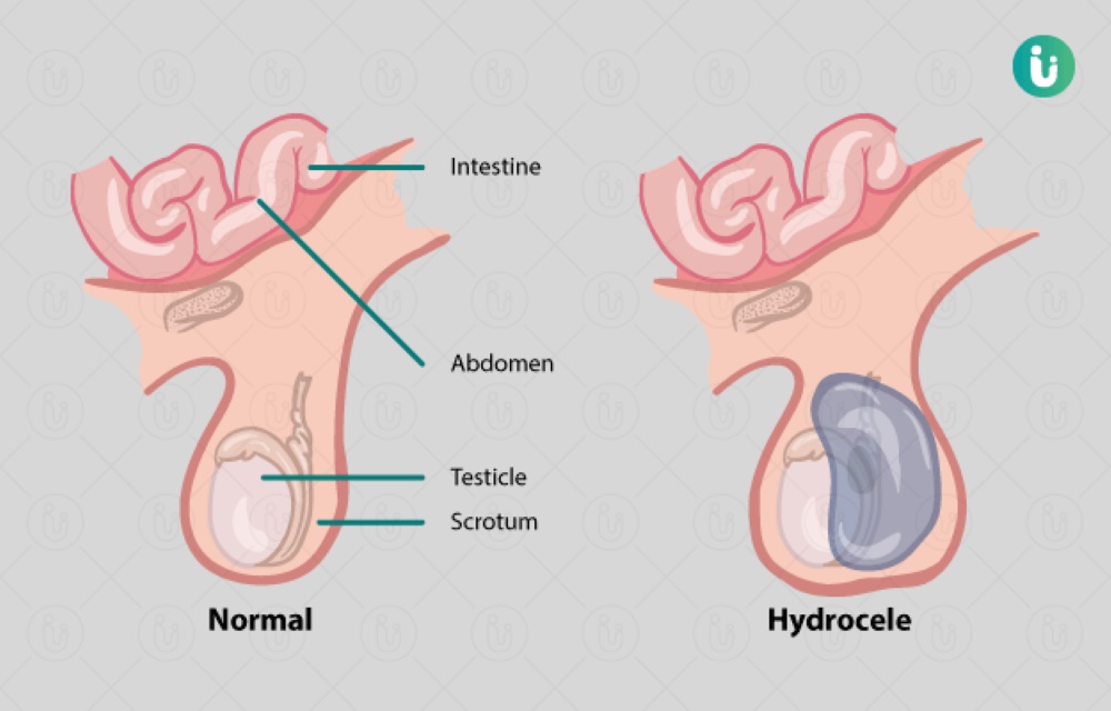 Reclaiming Comfort and Confidence: Hydrocele Operation and Hernia Surgery at Urovita Hospital