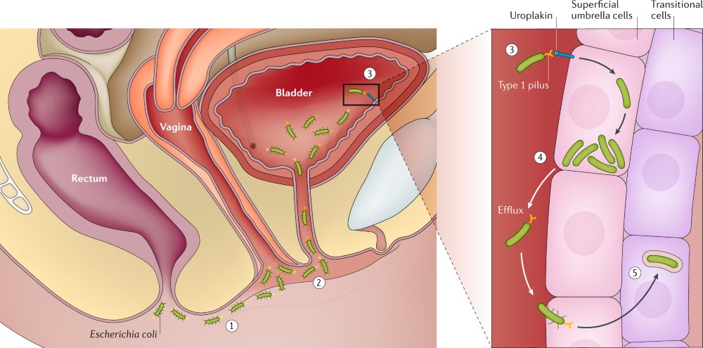 Recurrent Urinary Tract Infection management