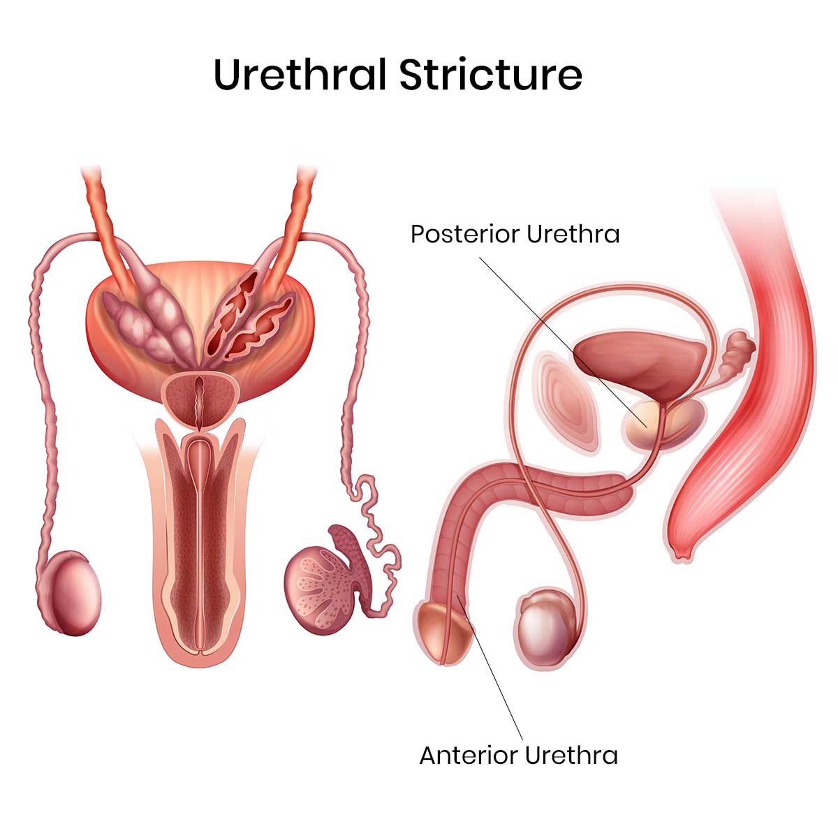 urethral stricture and its treatment, UIV urethroplasty at Urovita Hospital, jamshedpur