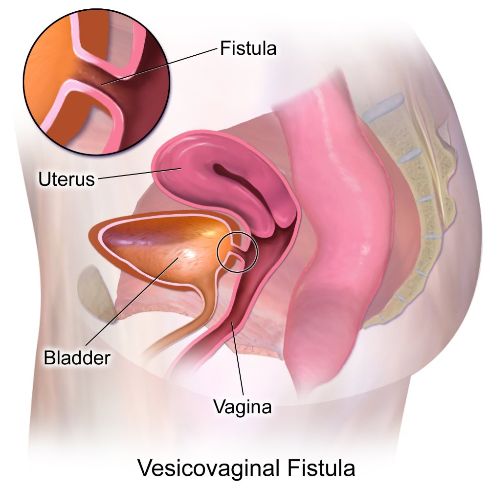 urogynecology – VVF repair, ureteric vaginal fistula repair – By urovita Hospital