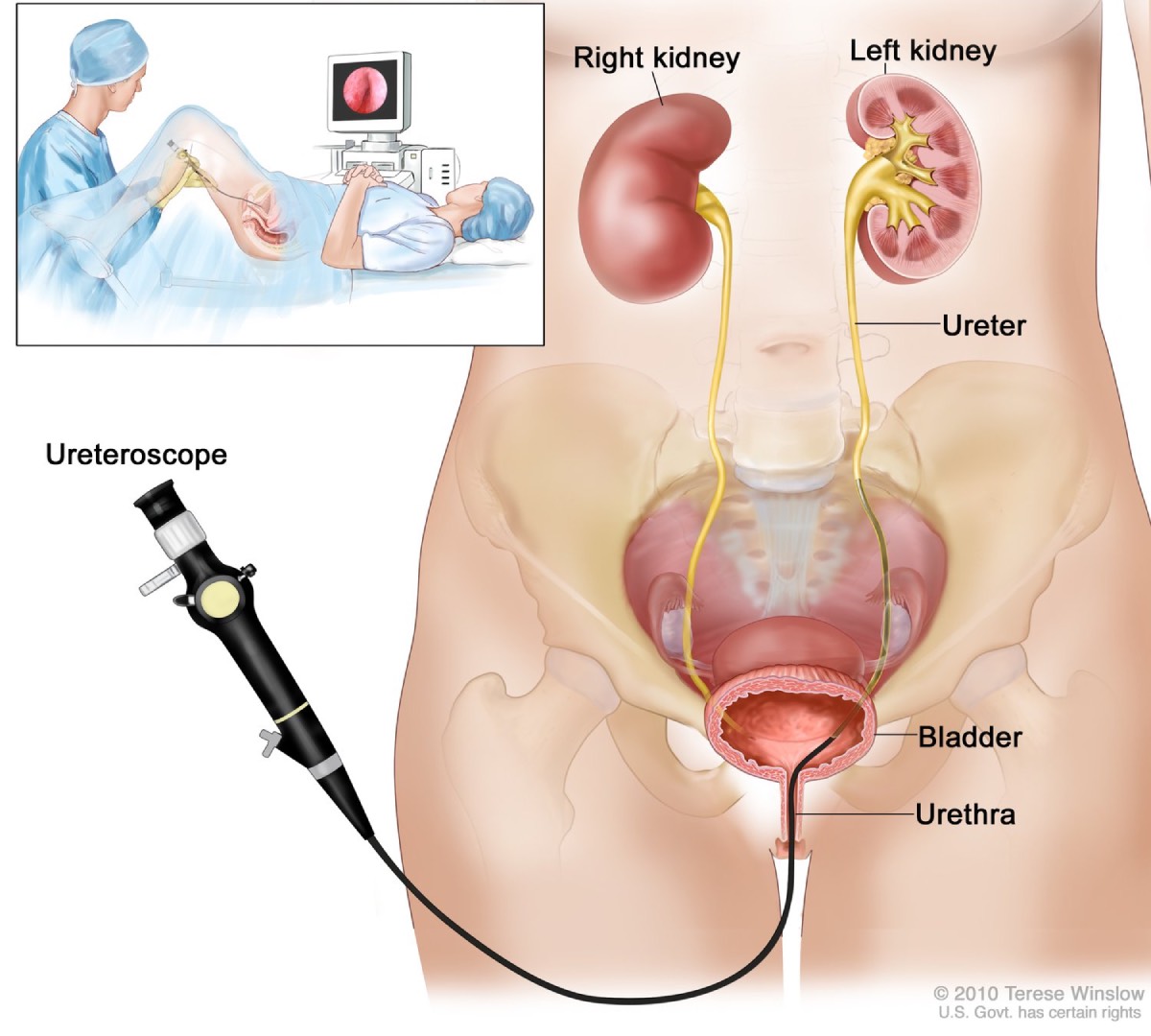 Ureteric stone treatment at Urovita Hospital, jamshedpur: URS, laser URS