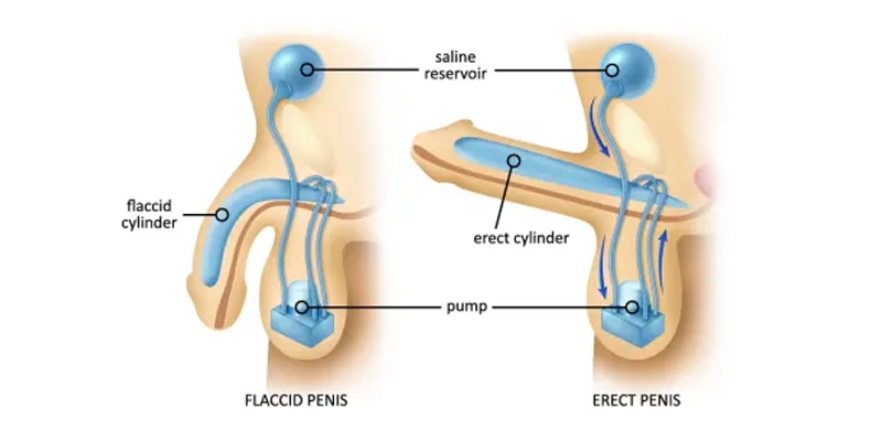 Treatment Of Erectile Dysfunction