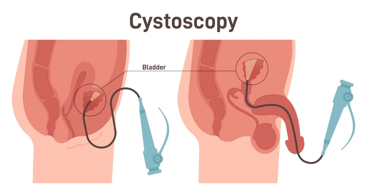 Cystoscopy Procedure